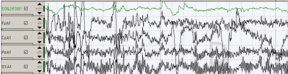gráfico-1-4-ondas-cerebrales-del-estado-de-vigilia-y-movimiento-ocular