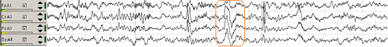 gráfico-3-ondas-cerebrales-fase-2-del-sueño-con-complejo-K