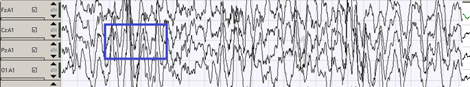 gráfico-4-ondas-cerebrales-fase-de-sueño-de-ondas-lentas